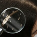 Pidocchi: come sono fatti, di cosa si nutrono e come si sviluppano